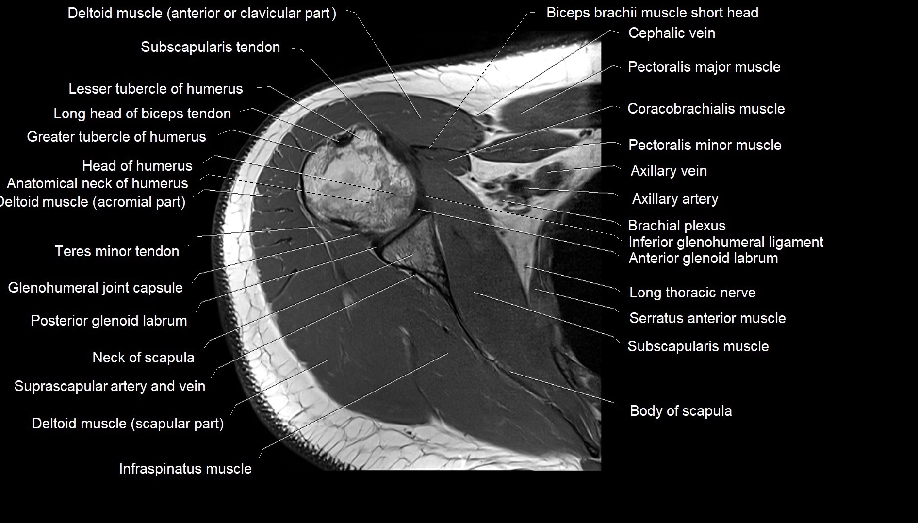 Shoulder cross sectional anatomy MRI 3T axial image 22.webp